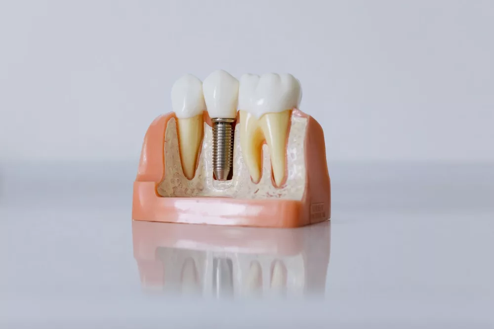 Unpacking ClearChoice Dental Implants: A Comprehensive Look at the All-on-4 Solution